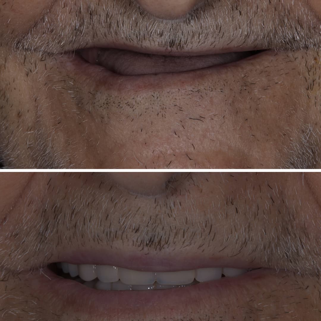 Dentures aren't obsolete just yet.