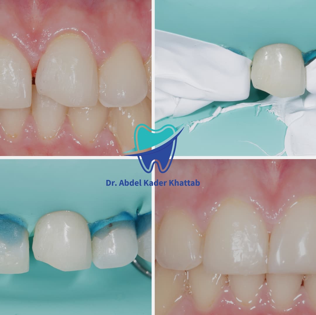 Class IV and Diastema Closure