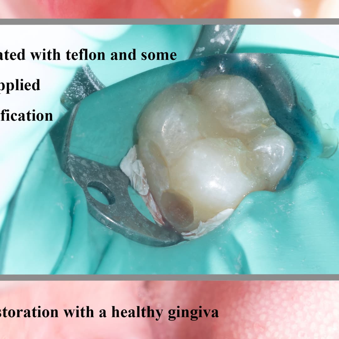 Class V on lower second molar.
