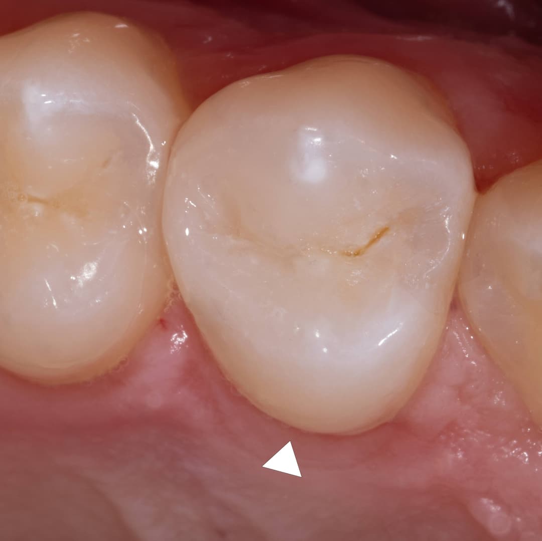 Class II on Upper Premolar.