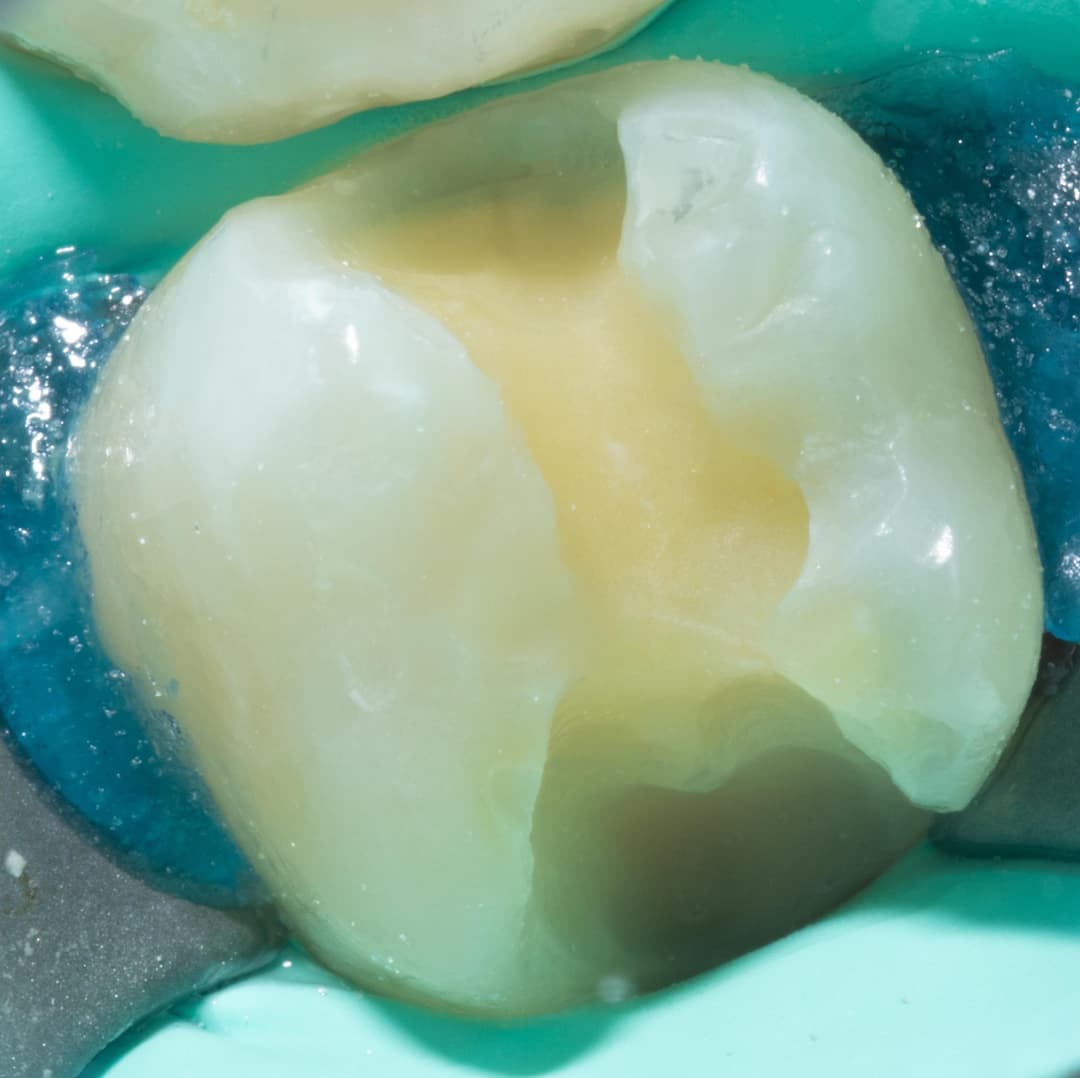 Class II MOD with deep distal margin.