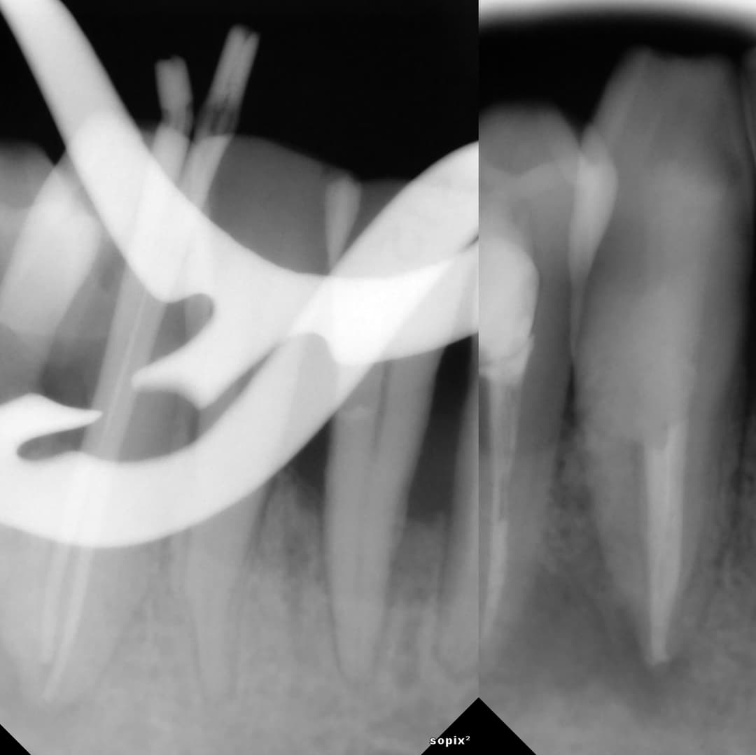 Lower Canine Endo+Resto