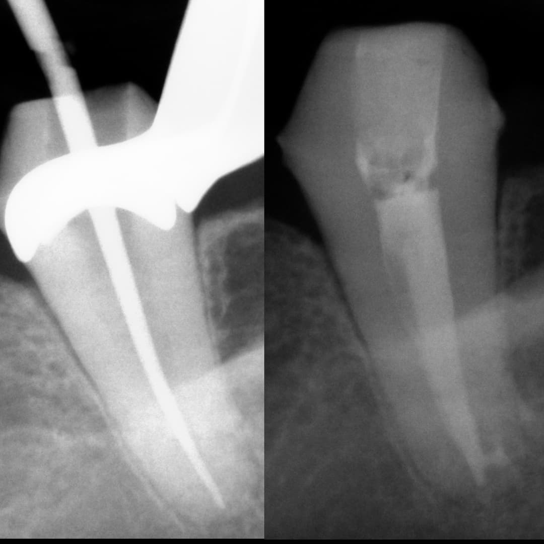 Lower Molar C-Shaped Canal