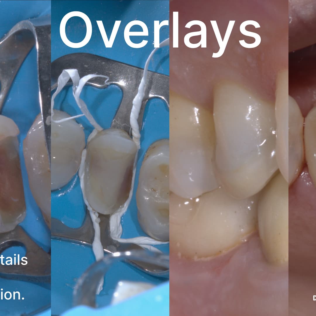 Overlay on Upper Premolar.