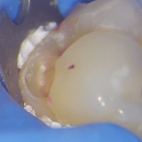 Teflon Isolation of Lower 8.