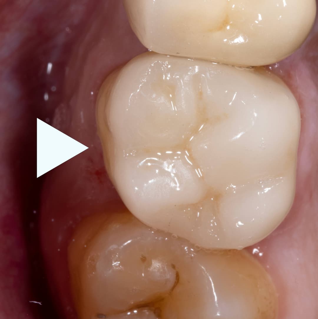 Overlay on Endo Treated Upper Molar.