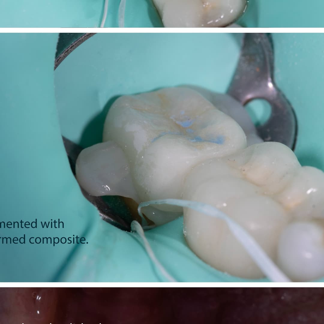 Overlay on lower second molar.