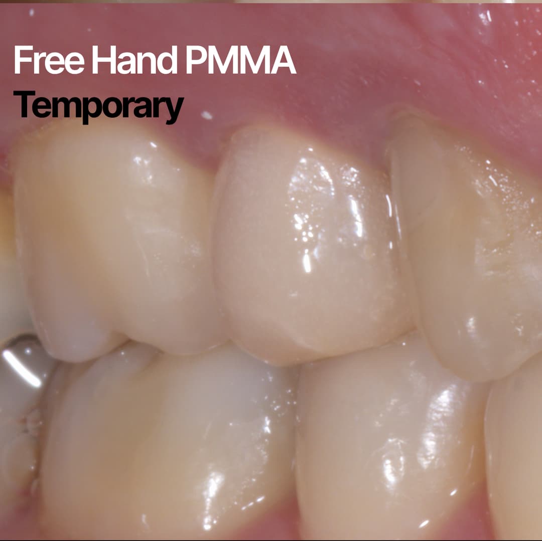 Free Hand Temporary PMMA